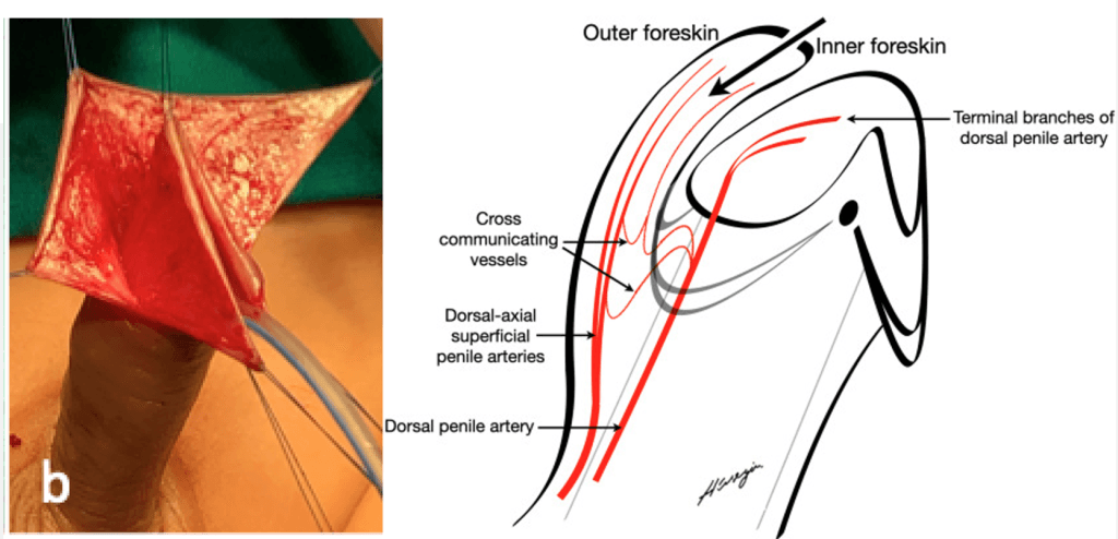 Glanüler hipospadias rekonstrüksiyonu için sünnet derisinin (prepusyum) anatomik modellenmesi.